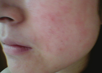 脸上过敏可以敷蜂蜜吗