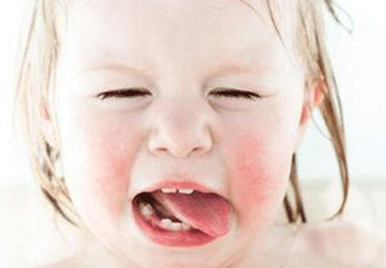 脸上过敏可以敷蜂蜜吗  脸上过敏 蜂蜜 美白祛黄 第2张