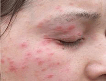 脸过敏了怎么快速脱敏的五大方法