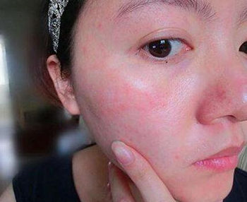 脸过敏了怎么快速脱敏的五大方法  脸过敏了怎么样快速脱敏 美白祛黄 第6张