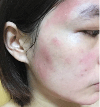 脸过敏了怎么办小偏方，治疗小妙招