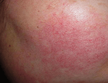 脸红有红血丝怎么办，五大方法直接去红