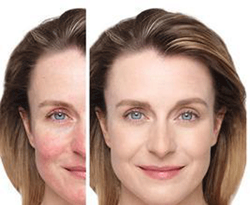 一热就脸红是什么原因