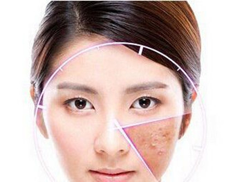 激素脸一般反跳多少次反跳期多久