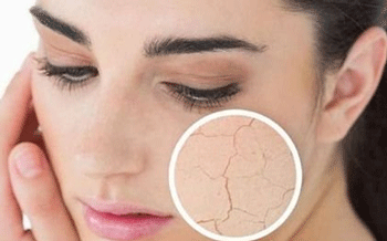 秋季脸上过敏很干怎么补水