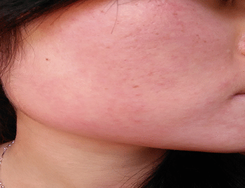 哺乳期脸上过敏怎么办？