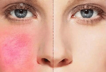 脸上过敏是什么样子  脸上过敏 美白祛黄 第2张