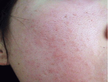 脸上过敏怎样快速消除的方法