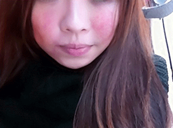 脸上过敏发红发痒偏方8个必看