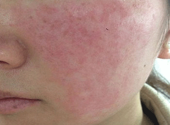 脸上过敏发红发痒怎么办