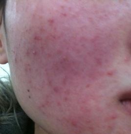 激素脸能自愈吗该怎么做才好