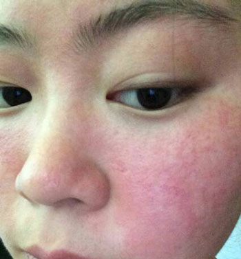 脸上过敏可以敷面膜吗