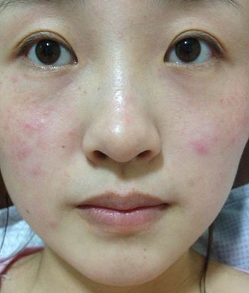 激素脸怎么调理有知道的么