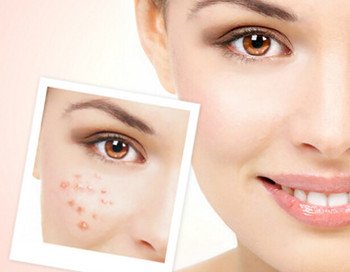 激素脸的症状，激素脸的治疗方法有啥