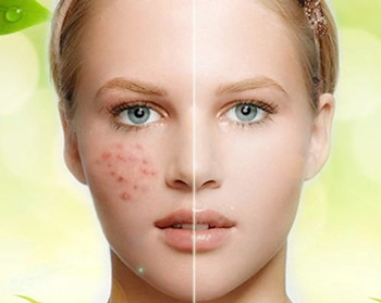 什么是激素脸，激素脸怎样治疗