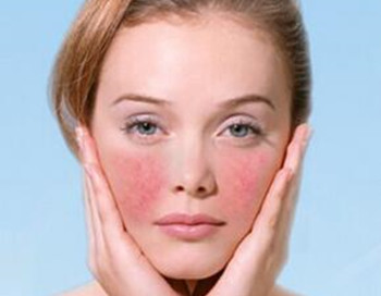 红血丝不治疗会怎么样  红血丝 美白祛黄 第2张