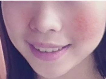 擦完护肤品脸热脸红什么原因怎么办