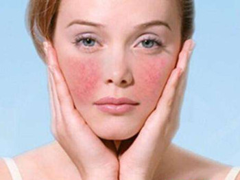 治疗面部潮红的土方法，小方法解决大问题  面色潮红 美白祛黄 第2张