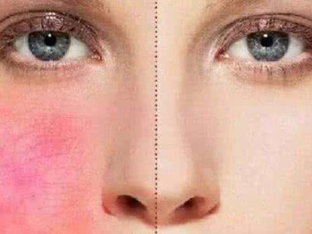 治疗面部潮红的土方法，小方法解决大问题  面色潮红 美白祛黄 第4张