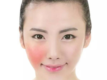 面部潮红和红血丝区别，4种方法快速区别