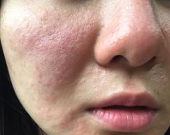 皮肤泛红肿脱皮怎么办，什么原因导致的  皮肤泛红 美白祛黄 第2张