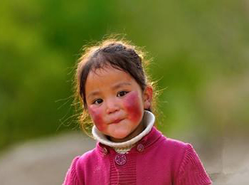 脸部高原红能自己消失吗，