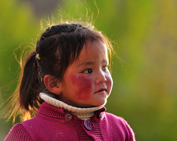 脸部高原红能自己消失吗，  脸部高原红 美白祛黄 第2张