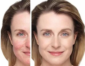 面色潮红皮肤发热是什么原因  什么原因 美白祛黄 第3张