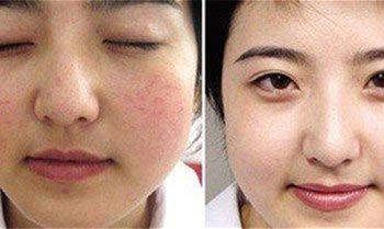 DPL去红血丝改善面部潮红有效果吗