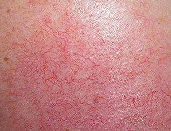 红血丝和红脸蛋的区别