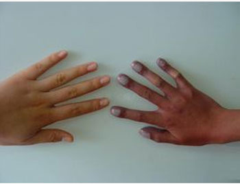 高原红细胞增多症症状及治疗  高原红 美白祛黄 第2张