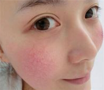 红脸蛋去除，有红脸蛋怎么办  红脸蛋 美白祛黄 第2张