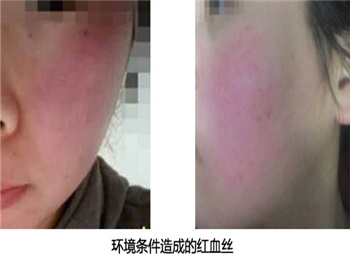 脸红是什么原因造成的，最有效的不脸红的方法  脸红是什么原因 美白祛黄 第5张