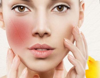 女生脸上出现高原红怎么办