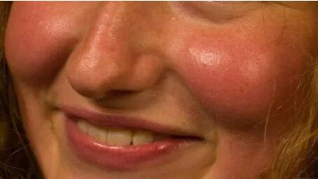 祛斑之后角质层薄如何修复