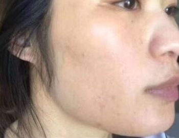 角质层薄的人怎么祛斑安全有效