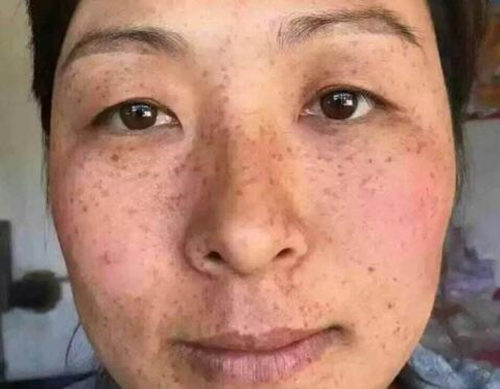 脸上角质层薄老了容易长斑吗，应该怎么办  角质层薄 长斑 美白祛黄 第2张