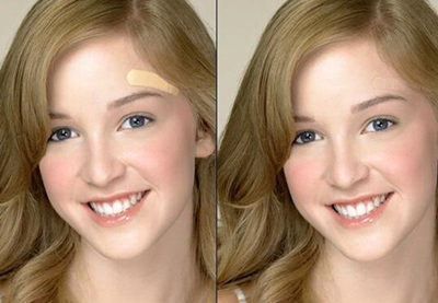 伤到真皮层是什么表现，该怎么修复才能变好  真皮层 美白祛黄 第2张