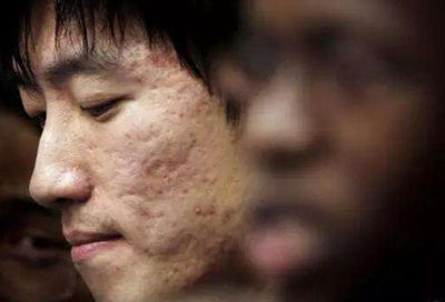 伤到真皮层是什么表现，该怎么修复才能变好  真皮层 美白祛黄 第3张