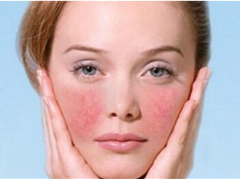 不健康的角质层有哪些表现，别让肌肤受损加重  角质 美白祛黄 第5张