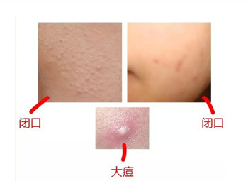 角质层薄还长闭口粉刺，原因及措施大揭秘
