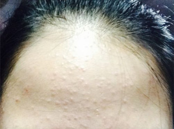 角质层薄还长闭口粉刺，原因及措施大揭秘  角质层薄 美白祛黄 第2张