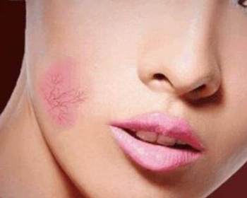 角质层薄能用撕拉面膜吗，不看毁脸  撕拉面膜 角质层薄 美白祛黄 第5张