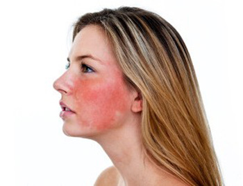 脸容易红是因为角质层薄吗，原因分析  角质层薄 脸红 美白祛黄 第2张