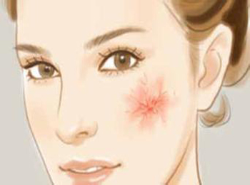 角质层薄皮肤红还能好吗  角质层薄 美白祛黄 第1张