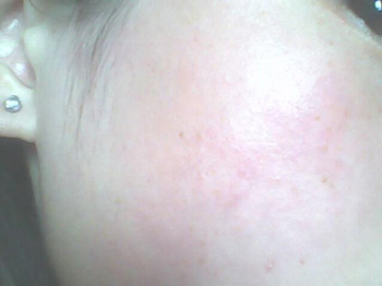 维生素A酸乳膏可以增厚角质层吗  维生素A酸乳膏 美白祛黄 第2张