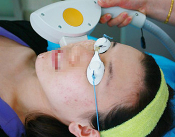 光子嫩肤会使角质层变薄吗  光子嫩肤 美白祛黄 第2张