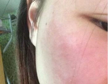 他克莫司治好了红血丝真的么，停用会爆发吗