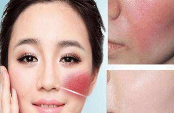 一月不洗脸红血丝好了可信吗