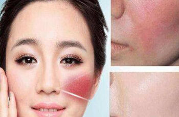 一月不洗脸红血丝好了是真的吗，  洗脸 美白祛黄 第2张